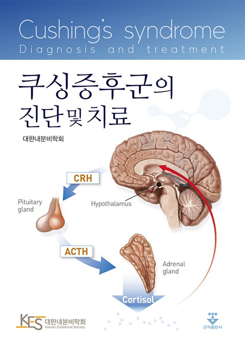 쿠싱증후군의 진단 및 치료 표지 이미지