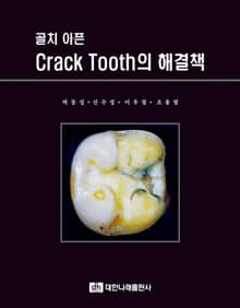골치 아픈 Crack Tooth의 해결책