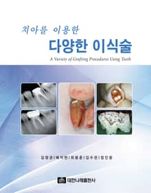 치아를 이용한 다양한 이식술
