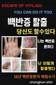 백반증탈출 당신도 할수있다